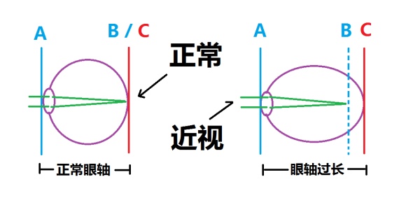 正常眼轴与近视眼轴对比